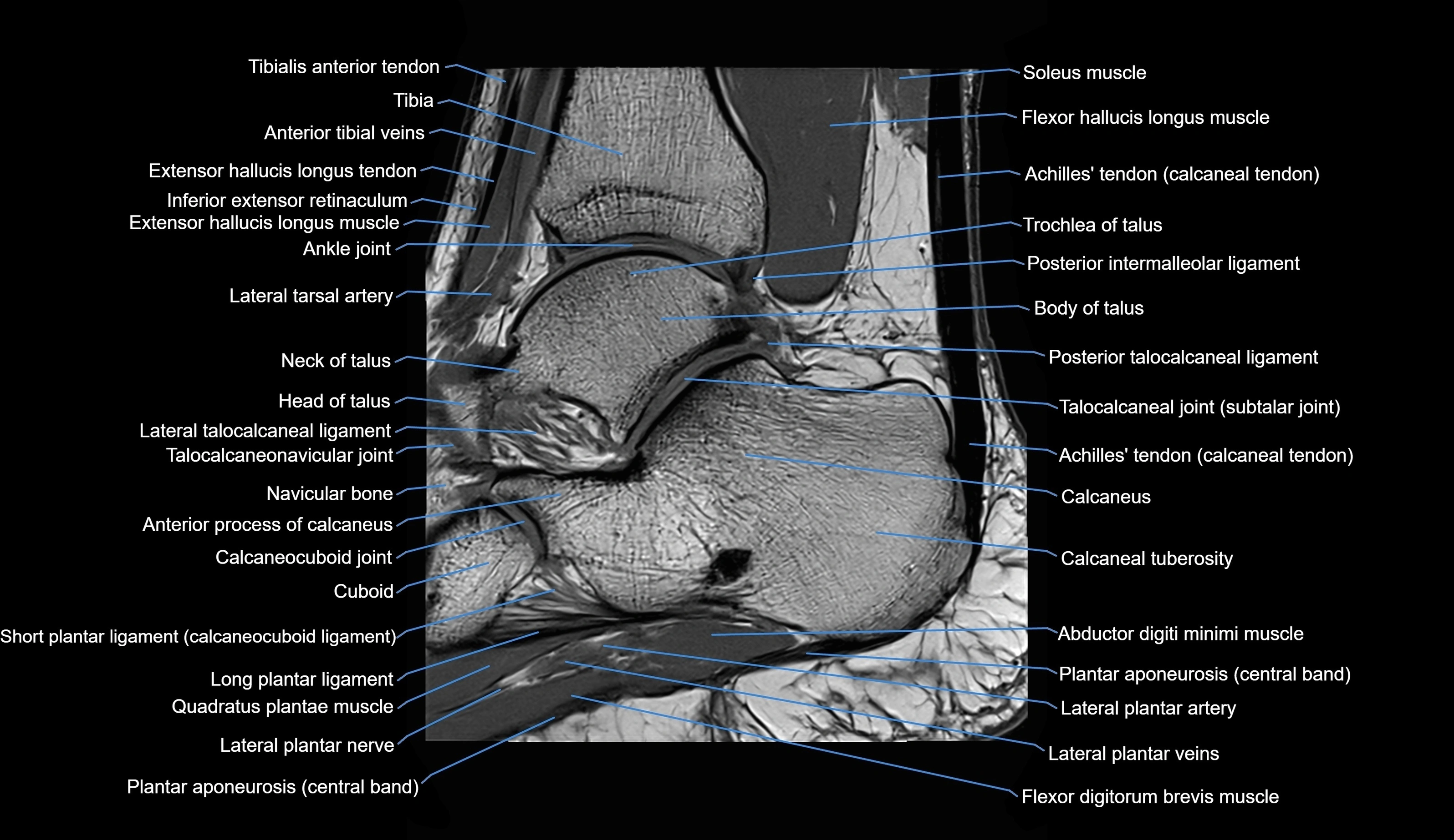 MRI Ankle sagittal cross sectional anatomy 3T  radiology  image-img-00001-00020.webp